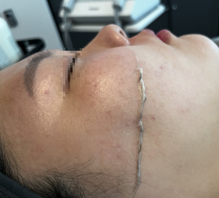  구월동 혜자뷰티에서 크라이오 더마 플래닝 받은 후기/ 구월동 에스테틱/스킨플래닝