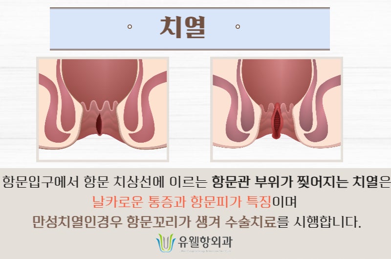 힐랩온항문심부속열기