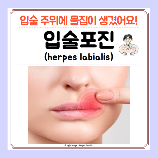  입술포진 입술 물집 헤르페스 단순 포진 원인 치료 아시클로버 연고