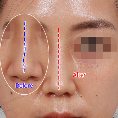  휜코교정으로 얼굴 밸런스 개선 < 강남신사휜코성형후기 치유 >