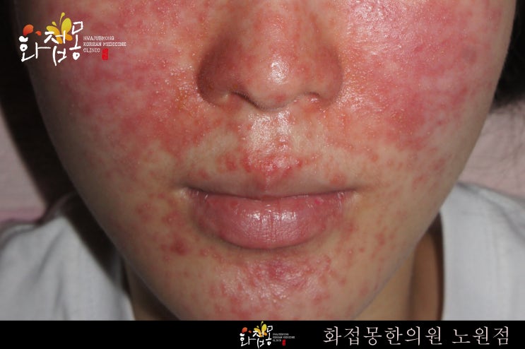  노원피부한의원 화접몽에서 지루피부염 치료하기