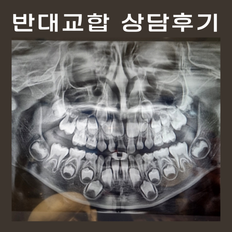  7살 반대교합으로 교정과 치과 상담 다녀온 후기 