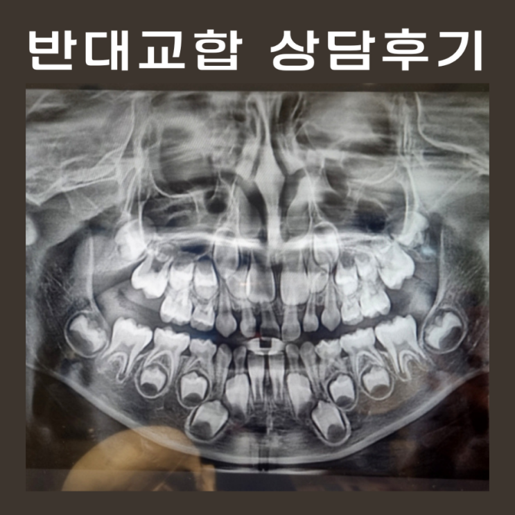 7살 반대교합으로 교정과 치과 상담 다녀온 후기 