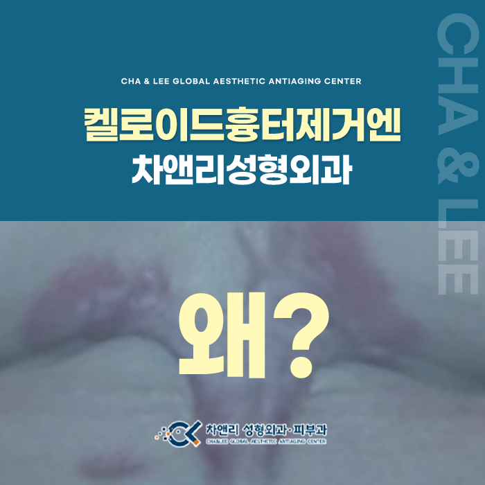  켈로이드흉터제거수술을 다시해야한다면