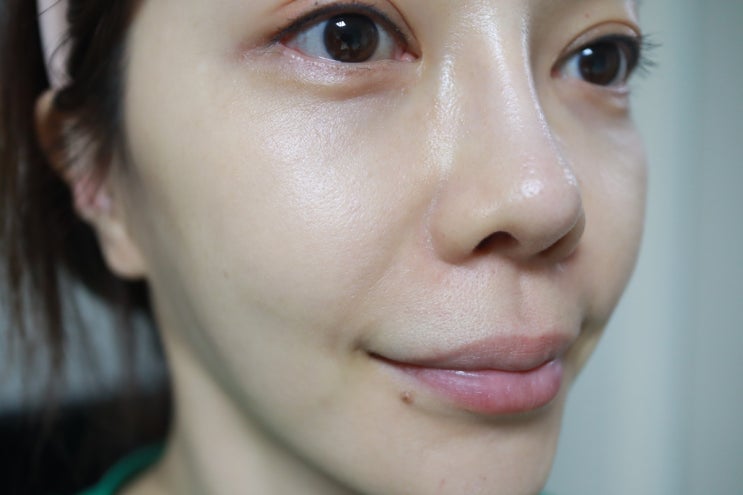  모공 시술 효과 좋았던 피코슈어, 프락셀레이저 대신 받아봄!