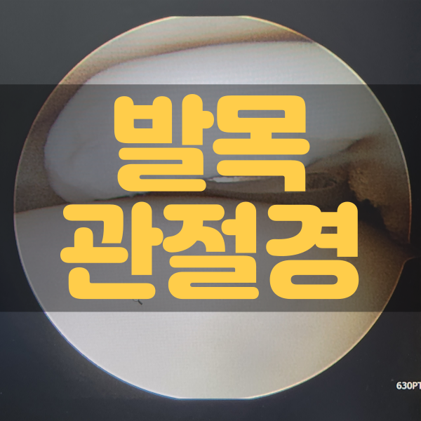  M939 S9348 / 인대손상되고 수술한 썰