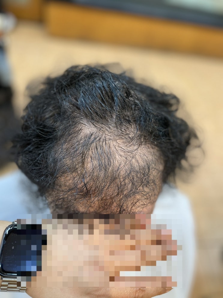  부산사하구 하단동에서 왔어요 모발이식해도 앞머리정수리휑하다 탈모성형펌 끝 [르네시떼사상미용실]탈짱샘