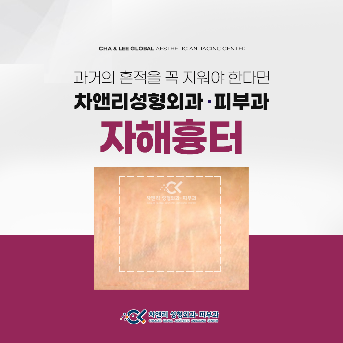  성형외과전문의에게 받는 손목과 팔의 자해흉터, 화상흉터