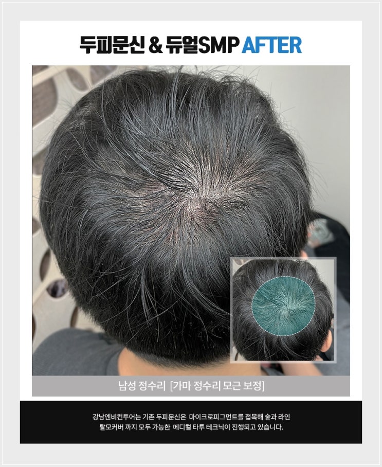  두피문신SMP 병원 메디컬타투 가 대세입니다