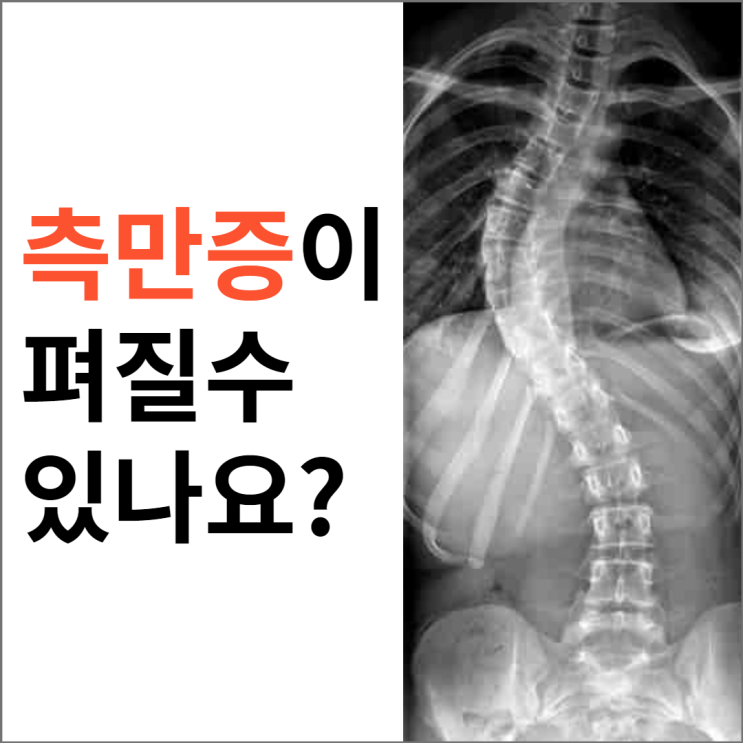 척추측만증이 펴질까요? 수술말고 추나요법 도수치료로? 척추측만증이 펴질까요? 수술말고 추나요법 도수치료로?