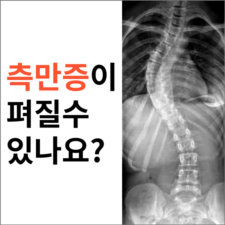 척추측만증이 펴질까요? 수술말고 추나요법 도수치료로?