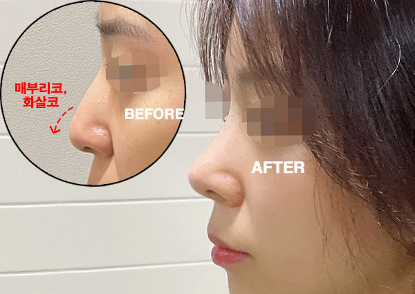  무보형물코수술, 자연스러운 라인으로(강남성형외과 치유)
