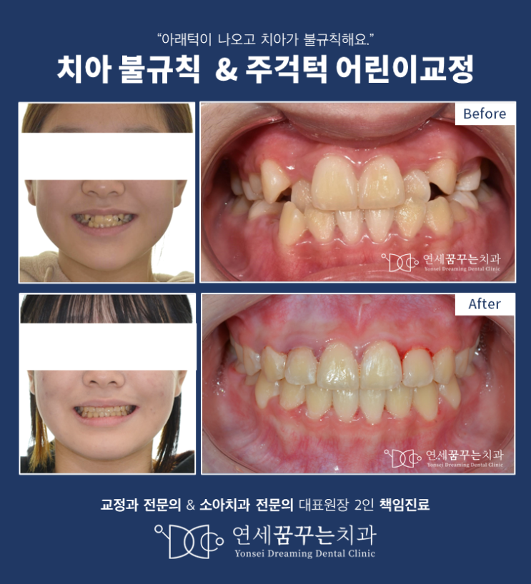 청소년기에 주걱턱 교정, 페이스마스크 치료 가능할까? 청소년기에 주걱턱 교정, 페이스마스크 치료 가능할까?
