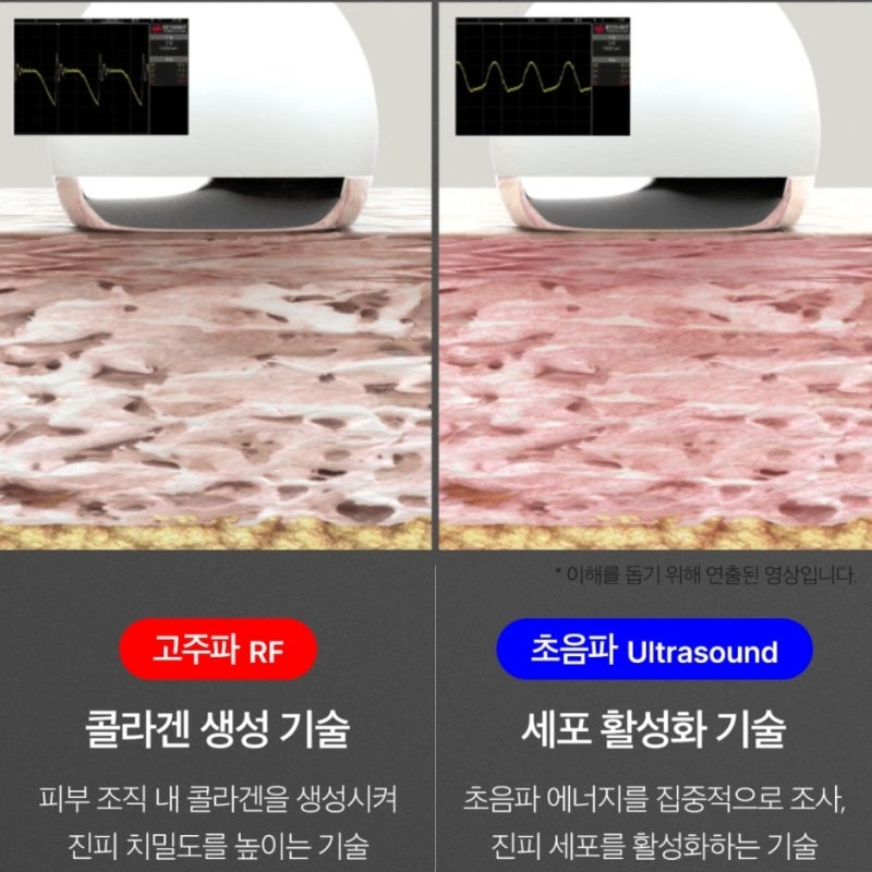 울쎄라 효과 내돈내산 피부관리비용 절감 추천 8개월 메디큐브 에이지알 유쎄라 딥샷 탄력 2배 순서, 사용법 : 네이버 블로그