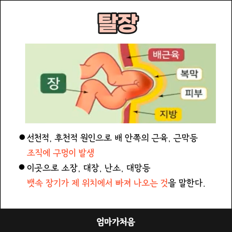 소아 신생아탈장 증상 종류 진단 치료 합병증 정리했어요 : 네이버 블로그