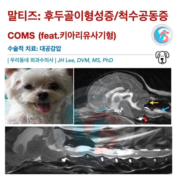  말티즈: 후두골이형성증/척수공동증COMS (feat.키아리유사기형), 수술적 치료: 대공감압