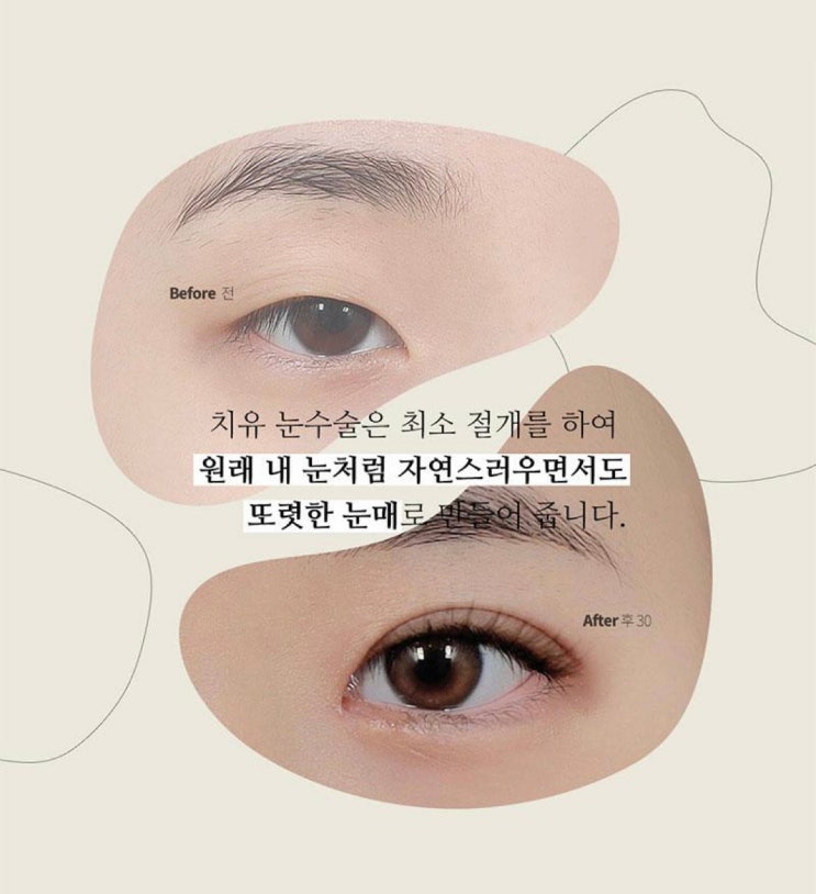 강남 눈성형잘하는곳 확실 변화! (치유성형외과)