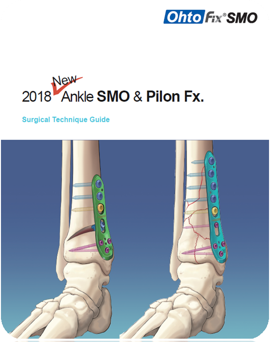Ankle-Supramalleolar medial open wedge osteotomy (SMO) 발목 관절염/ 원위경골 내측 ...