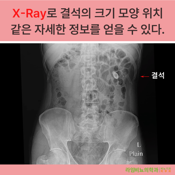  대구 동구 라임비뇨기과에서 요로결석에 대해 알아봅시다.