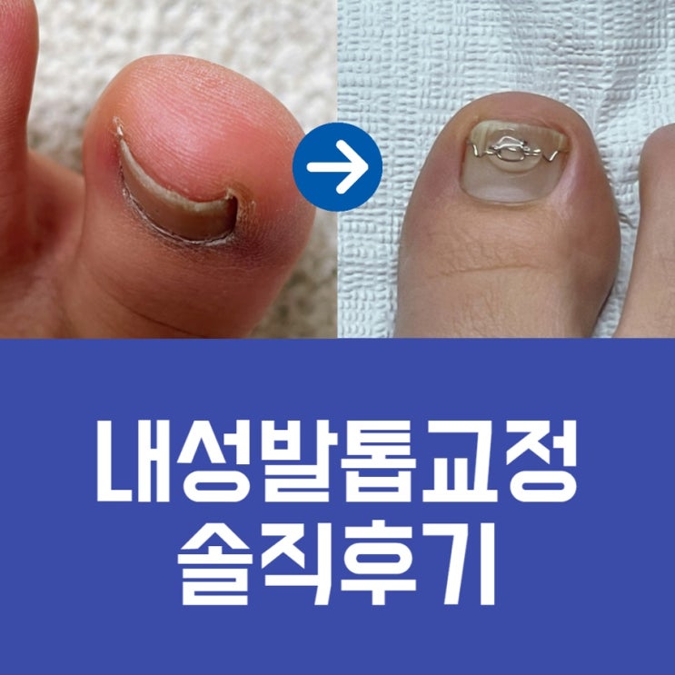 [평촌] 자연미인 & 베어푸스플레게 : 안양 내성발톱 전문점 교정 솔직후기 (+약혐주의)