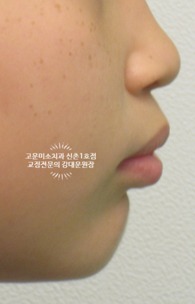  앞니돌출 벌어진 앞니 뚱한 입술 호두주름 과개교합 아래앞니결손을 가진 2급부정교합치료증례  신촌 교정전문의 고운미소 신촌1호점 치료증례