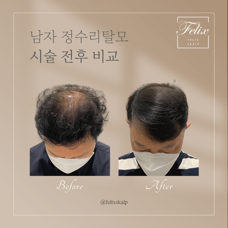  김포두피문신/탈모 때문에 스트레스 받는분들의 자신감 회복을 위한 탁월한 선택!김포SMP잘하는곳 필릭스스칼프(김포 간석동 제물포 역삼 잠실 군산)