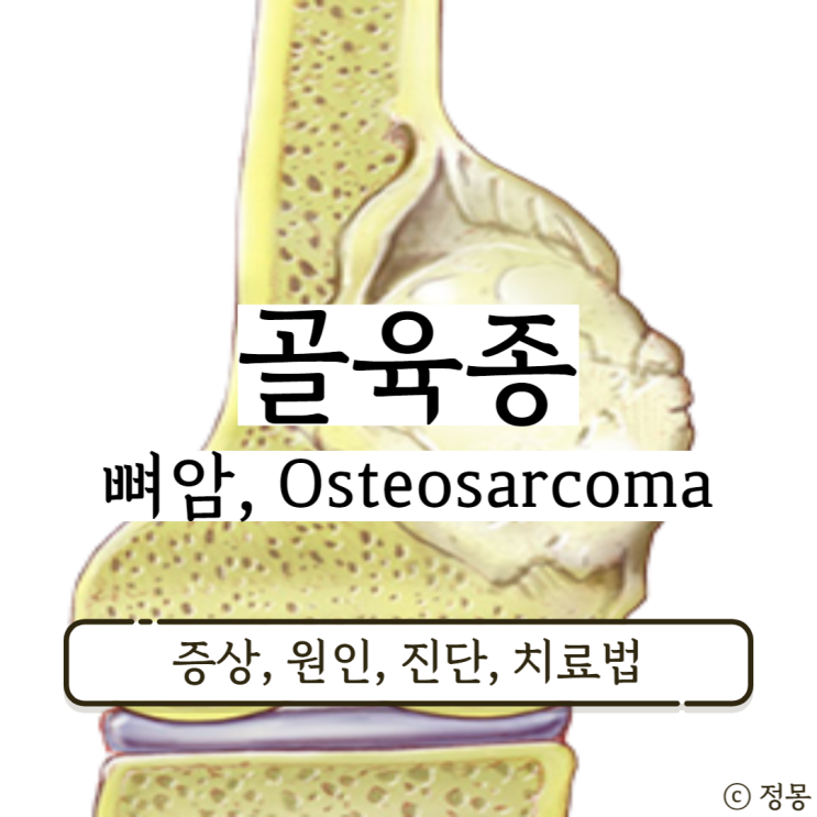 골육종 육종암 수술 뼈암 증상 원인 치료 골육종 육종암 수술 뼈암 증상 원인 치료