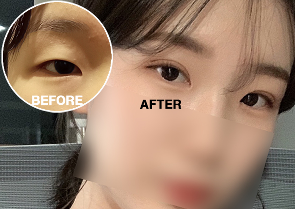  쌍꺼풀수술 후 무쌍에서 인라인 쌍꺼풀로!(압구정성형외과 후기)