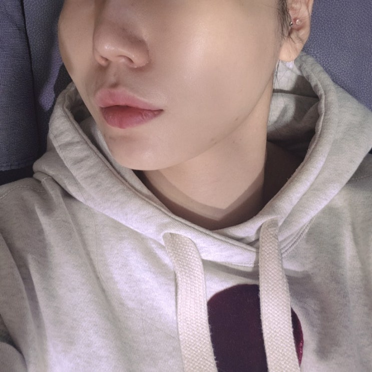  코 모공 레이저 종류 나비존 효과 실펌 엑스 X 2회차 ( 가격 및 부작용 솔직 후기 )