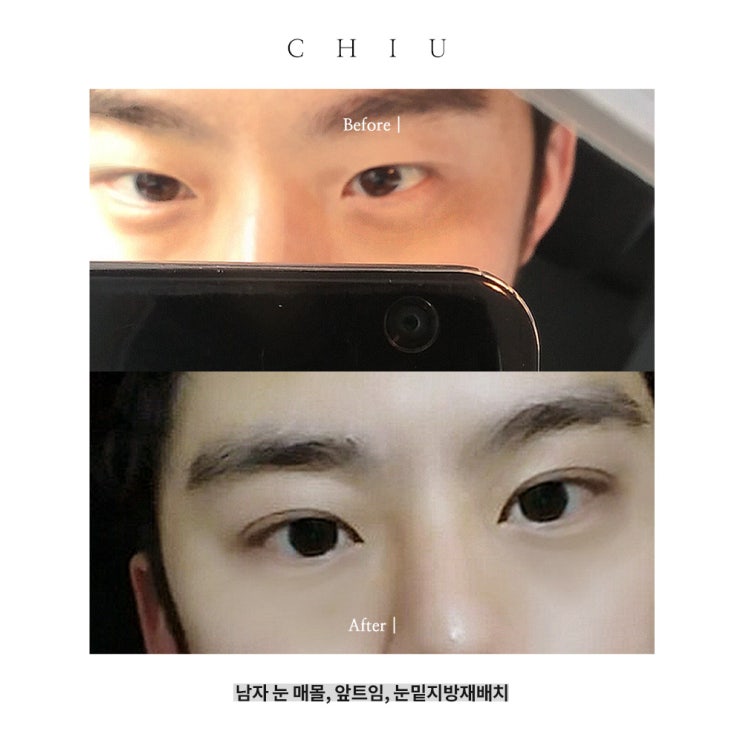  남자눈성형(매몰쌍꺼풀수술, 앞트임, 눈밑지방재배치)논현동성형외과