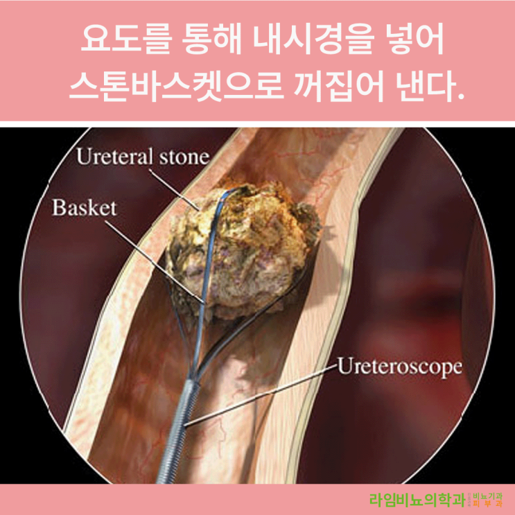  대구 동구 라임비뇨기과에서 요로결석의 치료방법에 대해 알아봅시다.