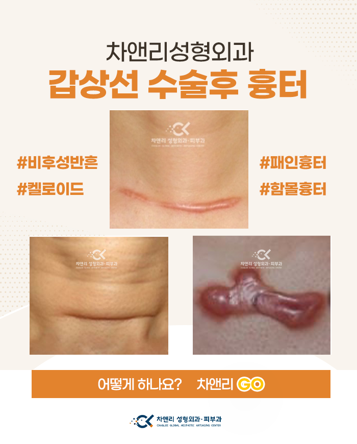  갑상선암 수술후 흉터종류와 관리 그리고 제거방법