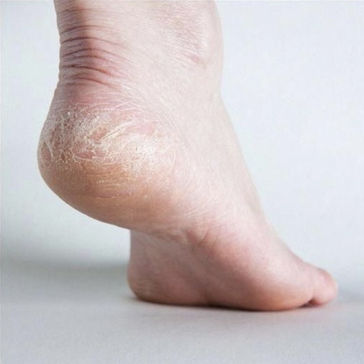  발바닥 발뒤꿈치 각질제거 매끈하게 관리하는 방법 tip