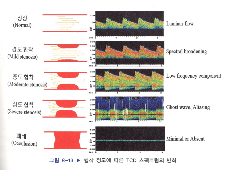 신경외과 검사: TCD 뇌혈류검사, 검사전후 간호 /결과해석 고 SAH : 네이버 블로그