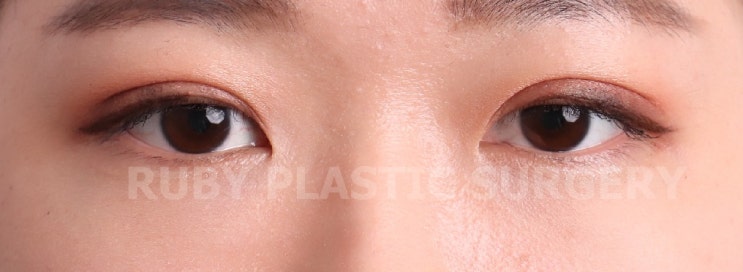 자연유착+비절개 눈매교정 3개월 후기(신사 루비성형외과)
