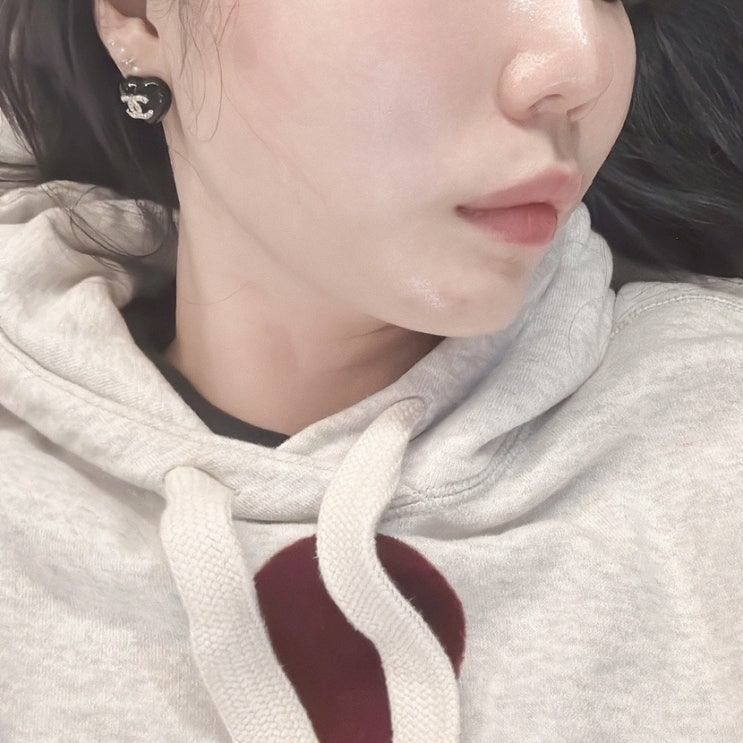  청담피부과 텐써마 후기 300샷 처진 볼살 리프팅 고주파 후기