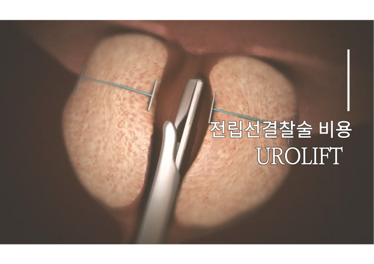 전립선결찰술비용과 선택 기준
