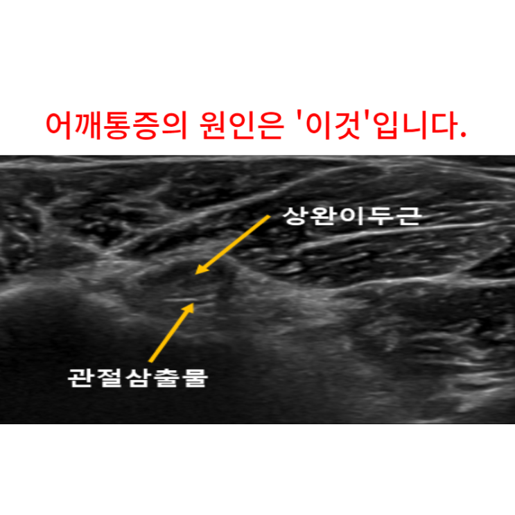  광주어깨통증, 원인은 '이것' 입니다
