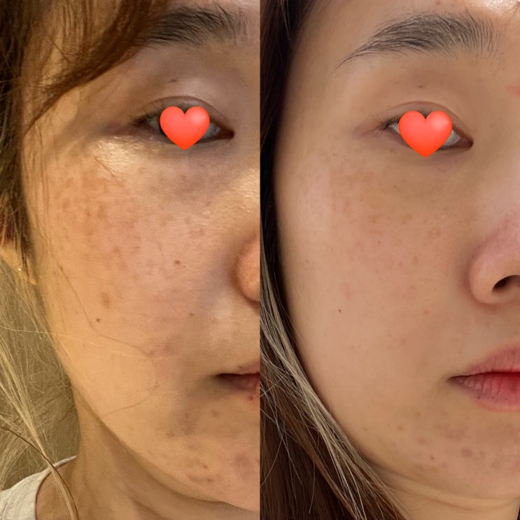  명동피부과 오타양모반 피코지우개, 피코토닝가격 1회 후기