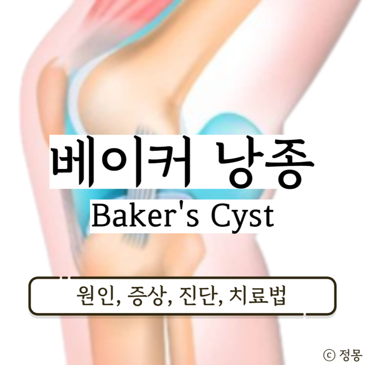 베이커낭종 무릎뒤물혹 치료법 원인 증상 슬와낭종 베이커낭종 무릎뒤물혹 치료법 원인 증상 슬와낭종