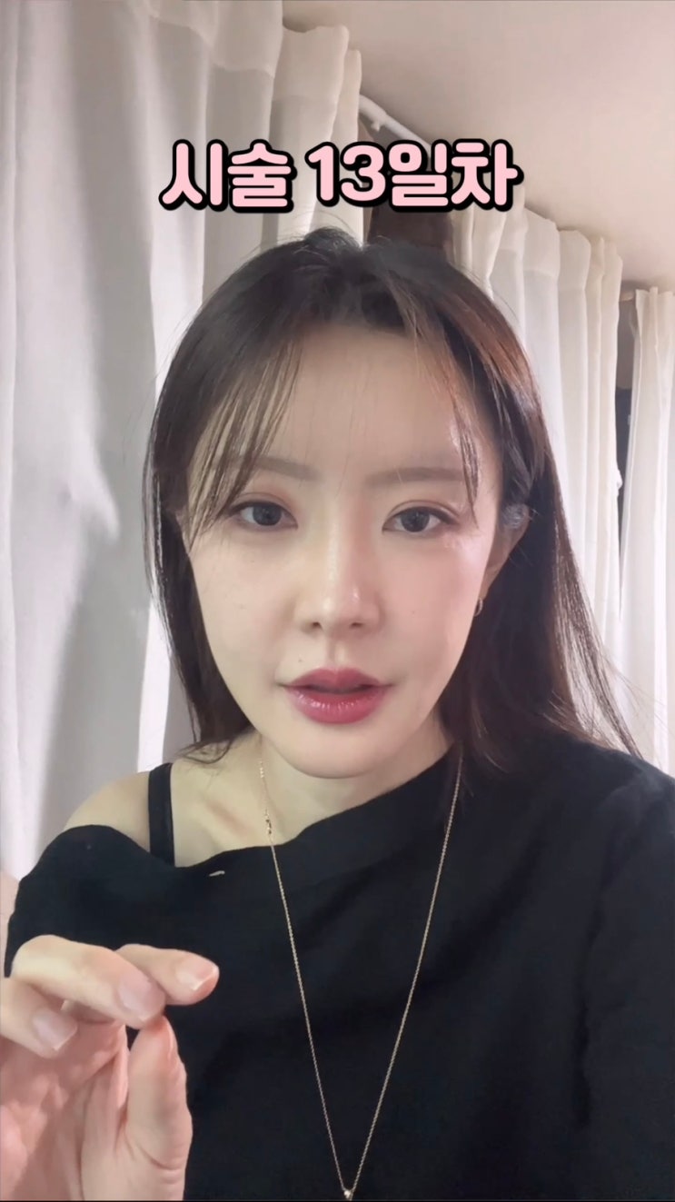  내돈내산 사각턱&이마&미간 보톡스 + 인모드fx + 윤곽주사 한달차 후기 : 효과 많이 봄 호옹이이이이 병원 바꾼 이유