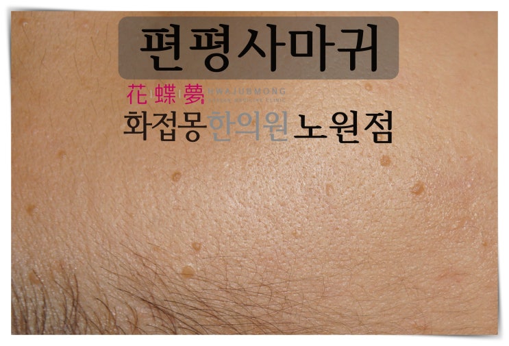  남양주편평사마귀 이것만 기억하세요