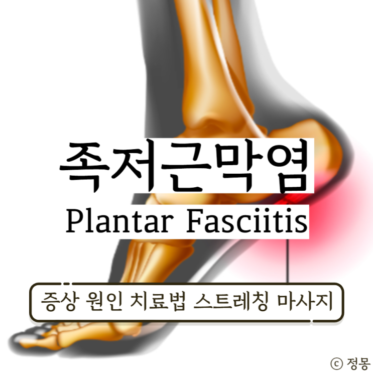 족저근막염 증상 치료 방법 스트레칭 마사지 족저근막염 증상 치료 방법 스트레칭 마사지