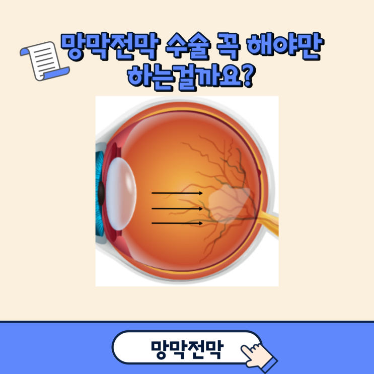 망막전막 수술 꼭 해야만 하는 걸까요?