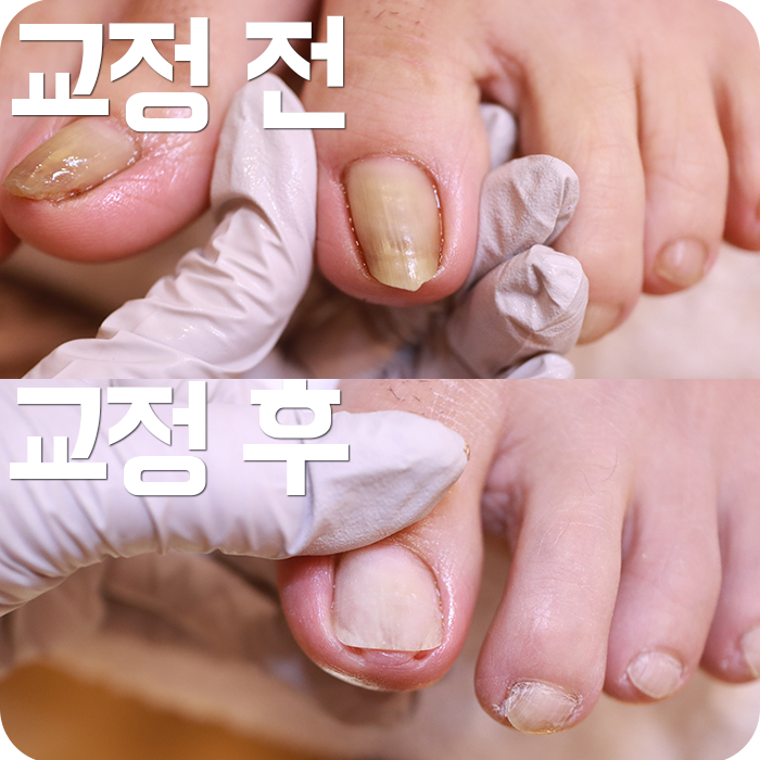 대구내성발톱 교정 오래된 증상도 깔끔하게 : 네이버 블로그 대구내성발톱 교정 오래된 증상도 깔끔하게 : 네이버 블로그
