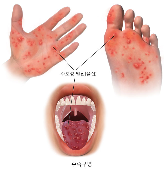 수족구병(손발입병) 원인, 감염경로, 주요 증상, 진단, 검사, 치료, 합병증, 예방 방법 : 네이버 블로그
