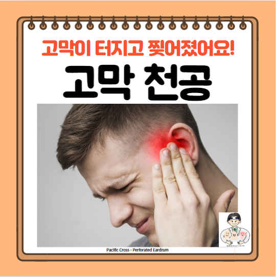  고막 천공, 파열 원인 증상 재생 수술