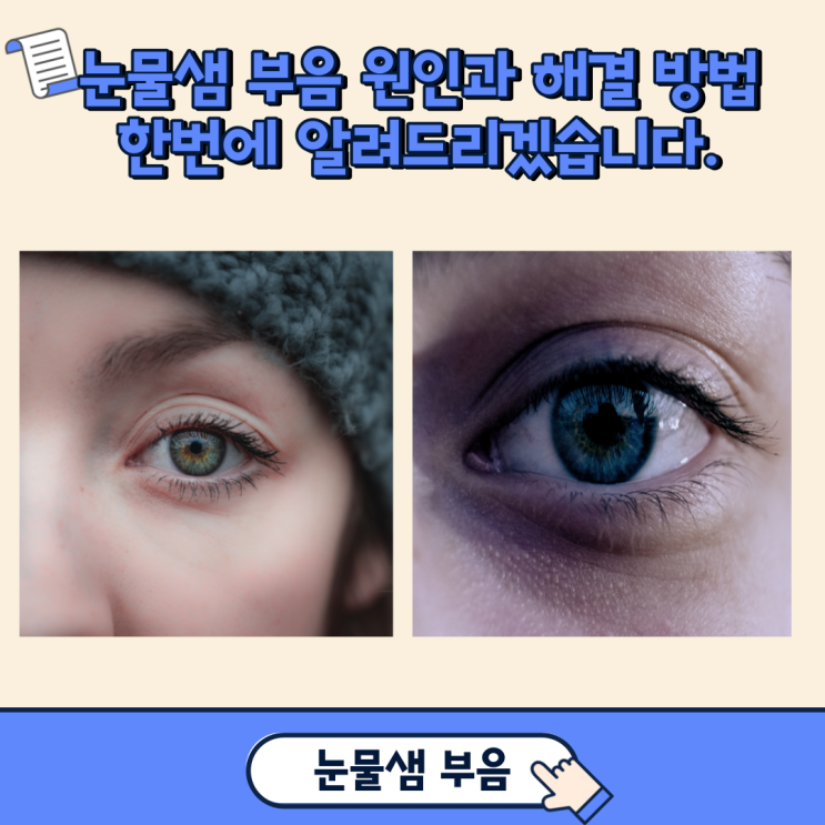  눈물샘 부음 원인과 해결 방법 한 번에 알려드리겠습니다.