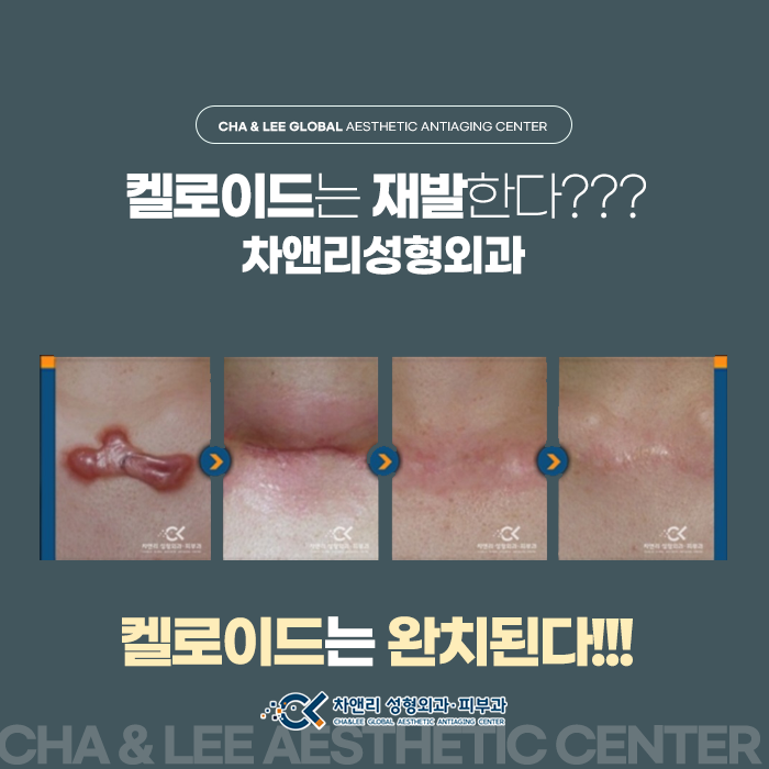  켈로이드가 재발되었다면