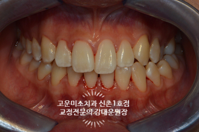  비대칭 정중선불일치  비발치 비수술 교정치료 신촌교정전문의 고운미소치과신촌1호점 증례